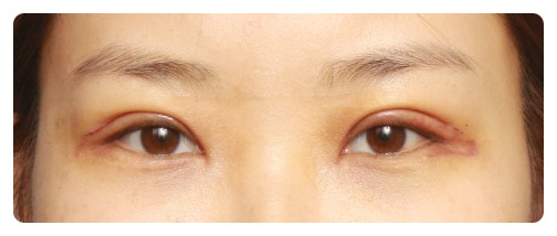 (재수술)라인이 풀어진 경우                [안병준의 눈이야기] 관련 이미지 2