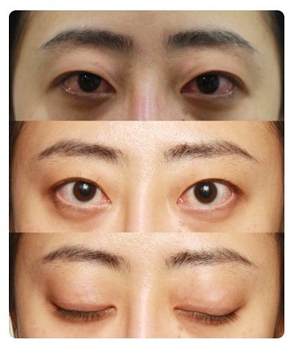 쌍꺼풀 라인크기 두껍게 한다고 정답은 아닙니다 관련 이미지 5