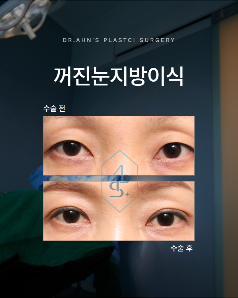 꺼진눈지방이식 볼륨을 채우기 전에 먼저 고려해야 할 점은 관련 이미지 1