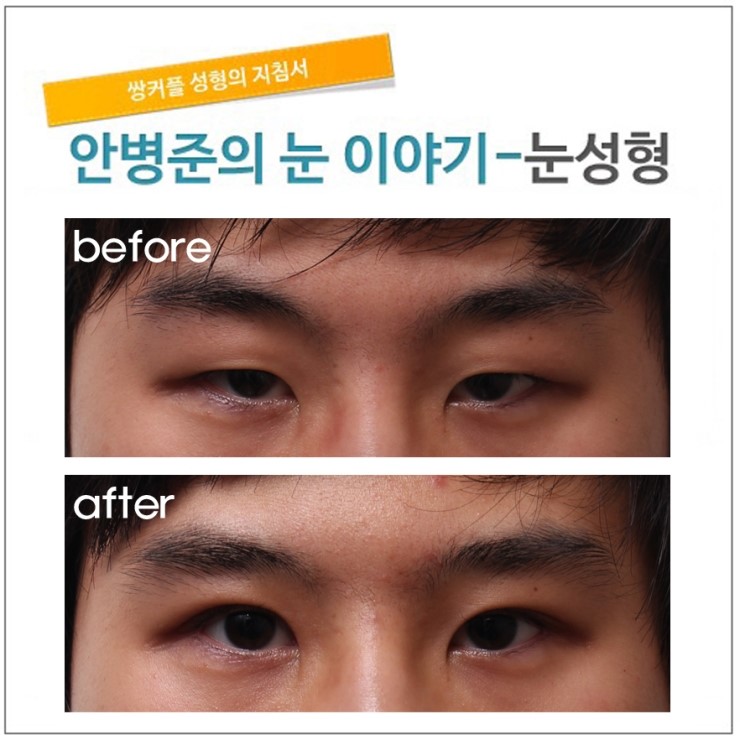 피부처짐과 안검하수의 공존 관련 이미지 1