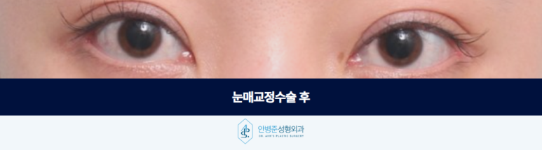When Double-Eyelid Surgery Alone Is Not Enough for Creased Folds and Sunken Eyelids: Eye-Opening Correction Surgery image 3