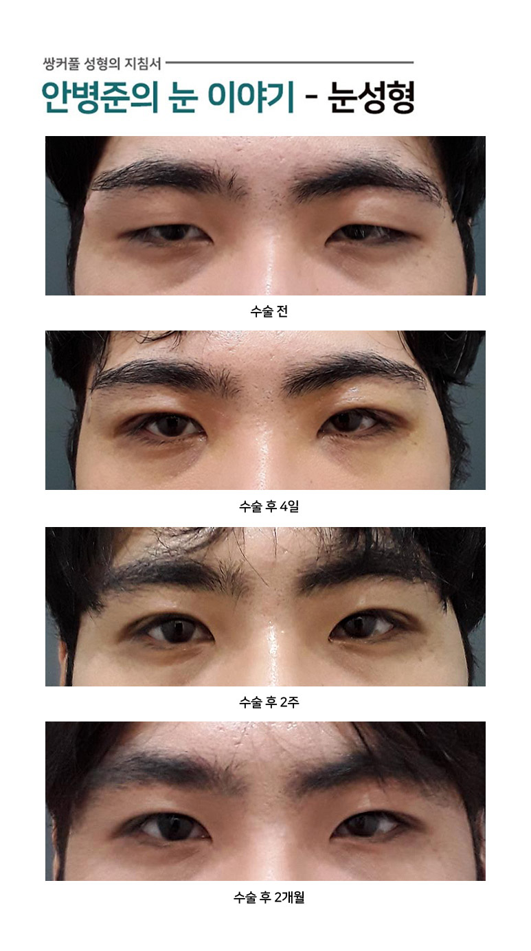 남자눈 심한 안검하수 - 쌍꺼풀수술과 눈매교정 관련 이미지 1