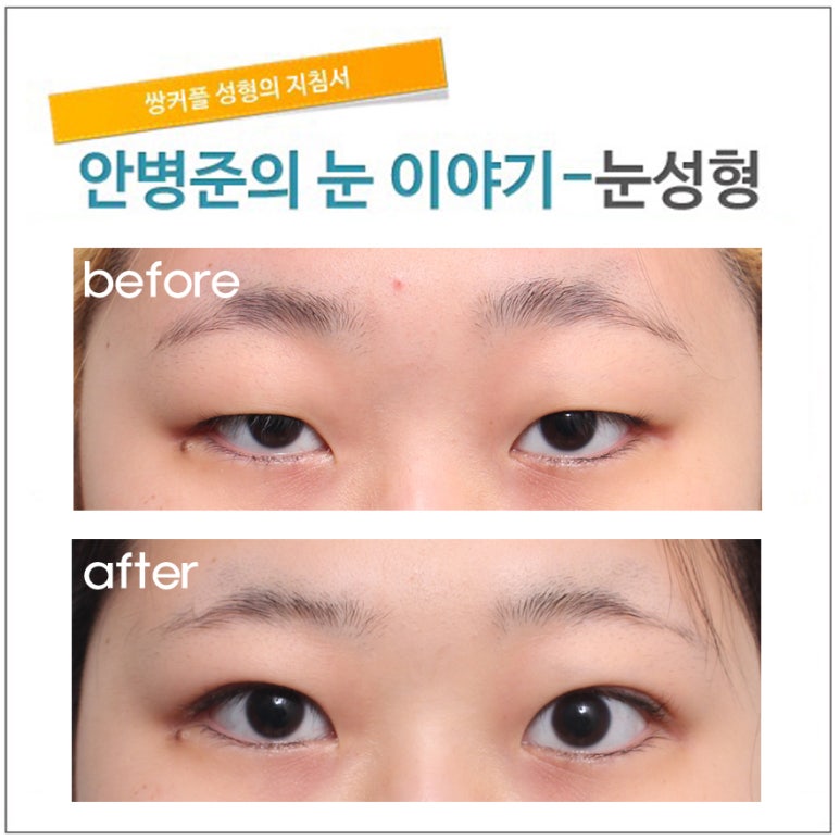 가성 안검하수 관련 이미지 1