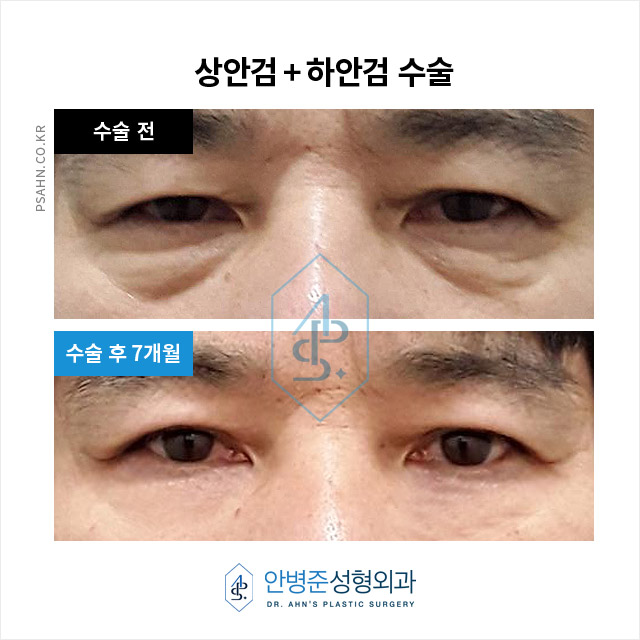 [중년눈성형] 중년 이후 눈 성형, 상안검과 하안검의 역할은? 관련 이미지 6