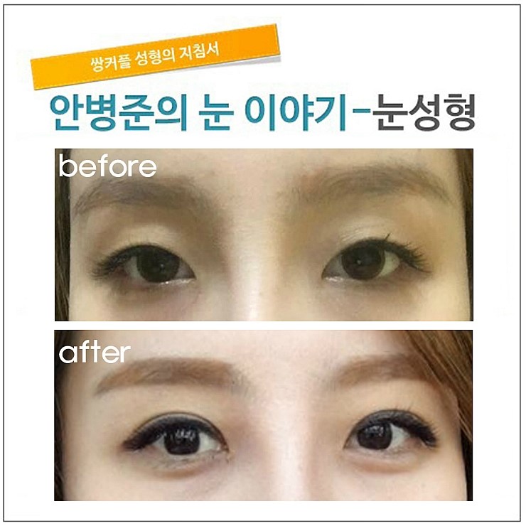 안검하수 외의 눈매교정이 필요한 경우.(안검하수,눈매교정) 관련 이미지 1