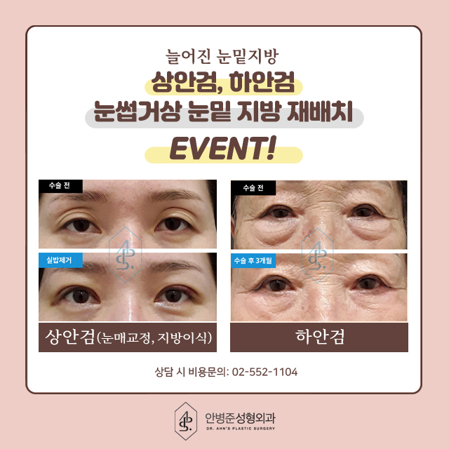 [이벤트] 상안검,하안검,눈썹거상 눈밑 지방재배치 관련 이미지 1