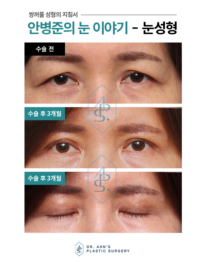 [눈썹밑상안검] 졸려보이는 눈매 및 처진 눈꺼풀 개선 관련 이미지 2