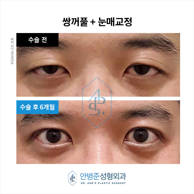[눈성형]피부 처짐으로 가려진 안검하수, 정확한 진단! 중요합니다 관련 이미지 3