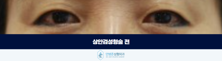 상안검성형술 처진 눈꺼풀로 고민이라면 확인해야 할 것 관련 이미지 2