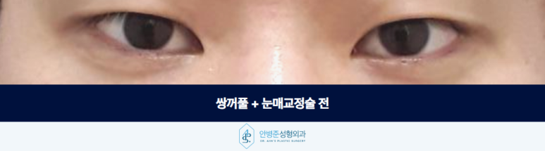 쌍꺼풀 수술 눈매교정술 남성 눈에서 더 신경 써야 하는 부분 관련 이미지 2