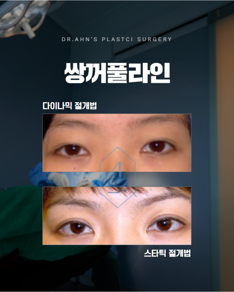 쌍꺼풀 라인 고정 자연스러움을 이끌어내는 기준 관련 이미지 1