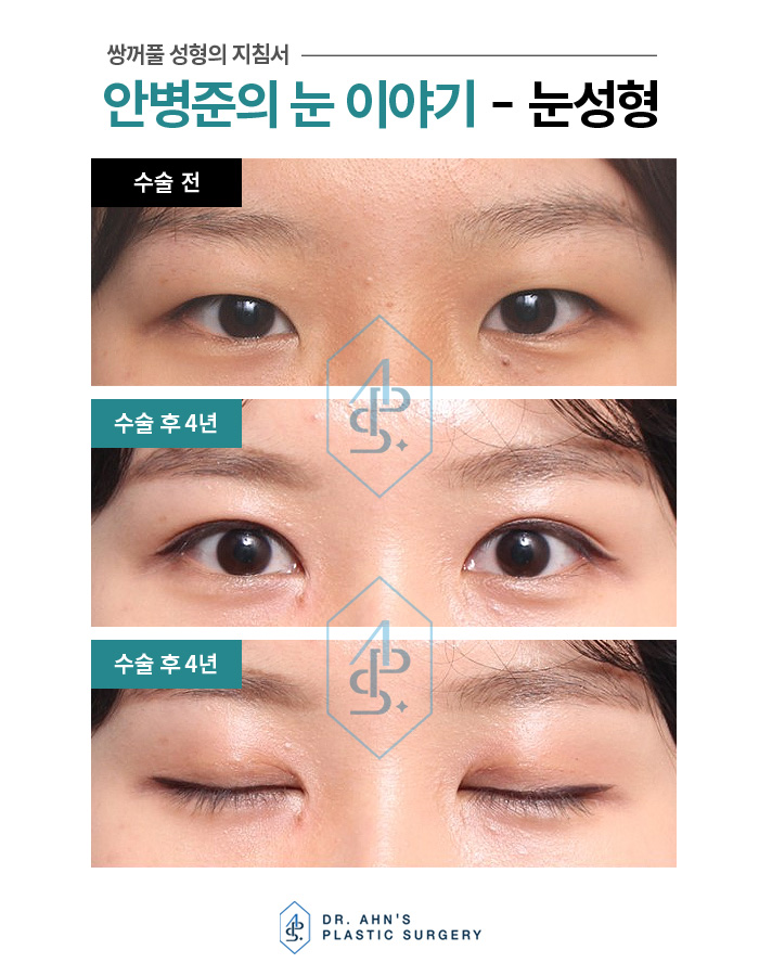 눈꺼풀과 눈두덩이가 두껍다? 피부저침? 절개법! 관련 이미지 2