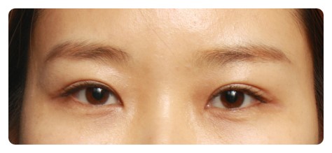 (재수술)라인이 풀어진 경우                [안병준의 눈이야기] 관련 이미지 3