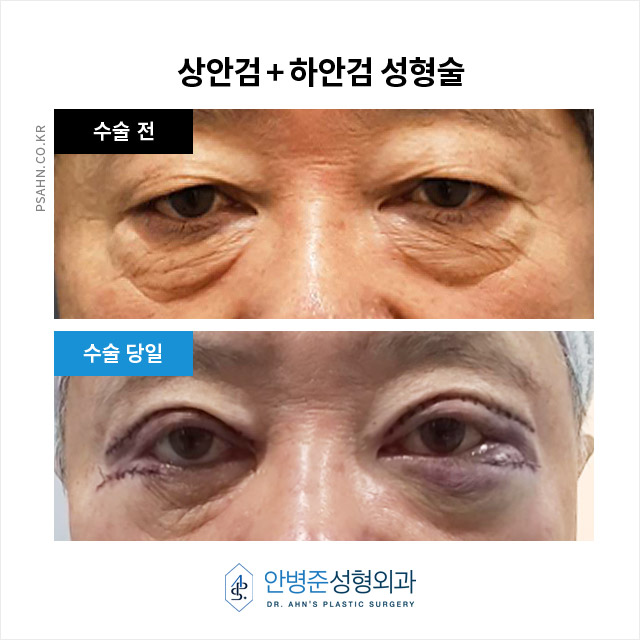 [상안검,하안검]100세 시대, 남성 상하안검성형술의 새로운 관심 관련 이미지 1