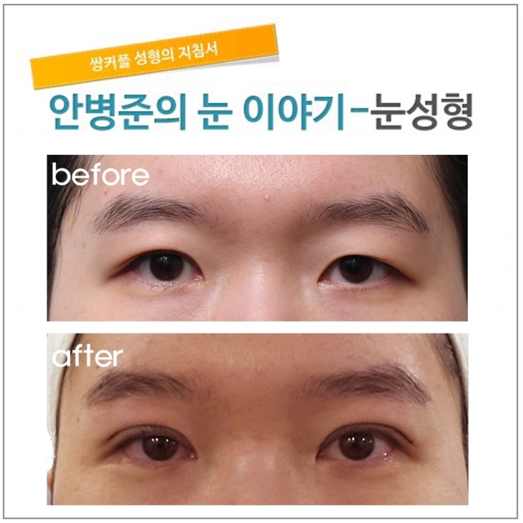 5년전 수술이 짝짝이로 풀린 눈. 관련 이미지 1