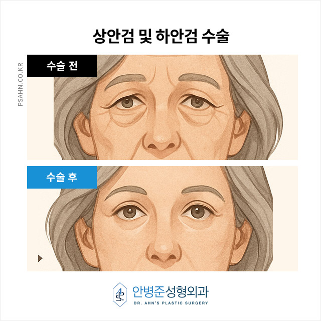 중년 눈성형, 처진 눈꺼풀 개선과 시야 확보까지?! 관련 이미지 5