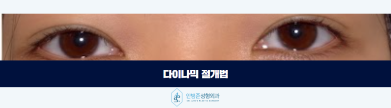 쌍꺼풀 라인 고정 자연스러움을 이끌어내는 기준 관련 이미지 5