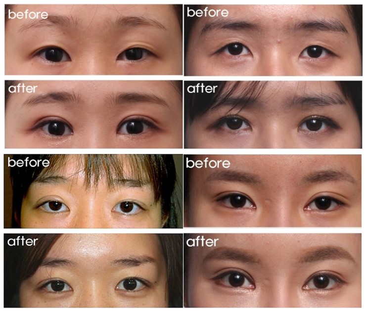 재수술 횟수(쌍꺼풀재수술) 관련 이미지 1