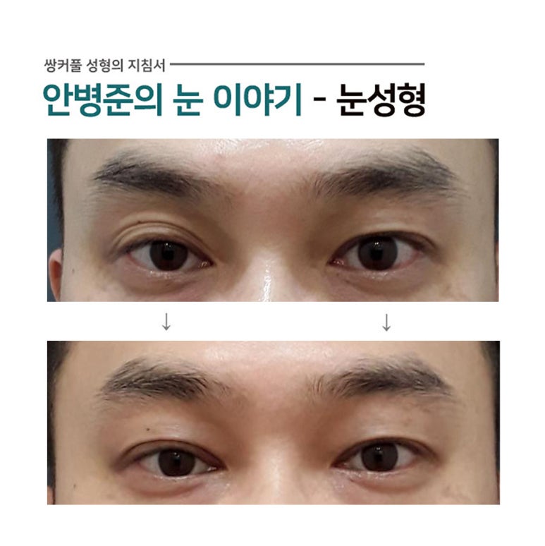 남자 쌍꺼풀 사례(짝눈,노인성눈,상안검성형술)#5~6 관련 이미지 1