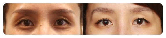 -쌍꺼풀 라인크기의 중요성-                [안병준의 눈이야기] 관련 이미지 3