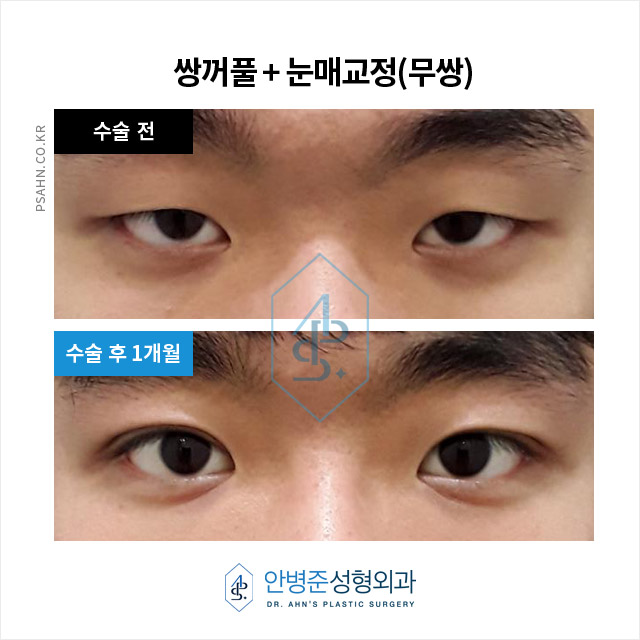 [남자눈성형] 개인의 외적 자신감 및 사회적 이미지 향상?! 관련 이미지 3