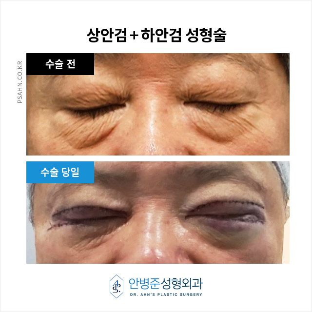[상안검,하안검]100세 시대, 남성 상하안검성형술의 새로운 관심 관련 이미지 3