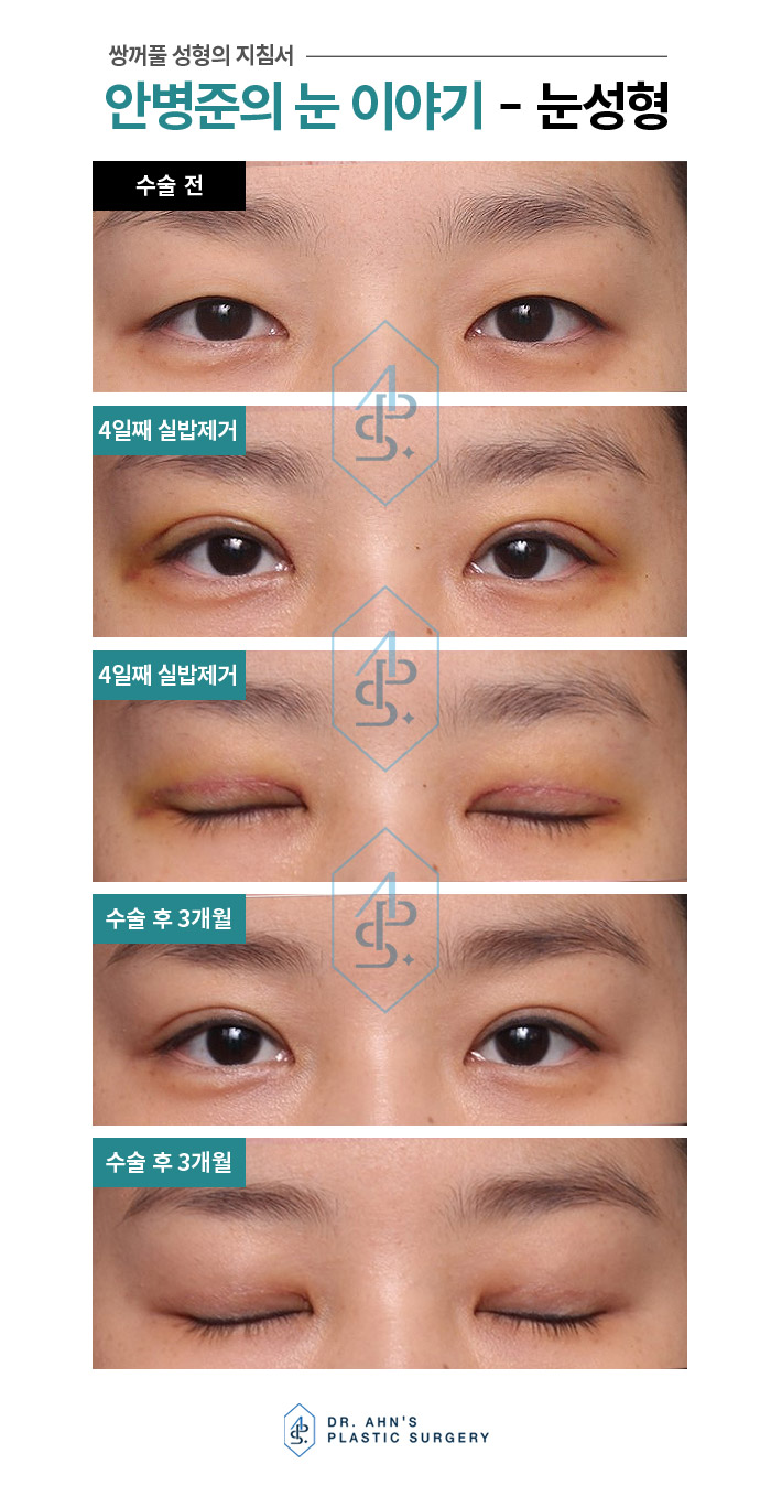 [자연스러운 쌍꺼풀] 4일째 실밥제거 / 3개월 후 사진 관련 이미지 3