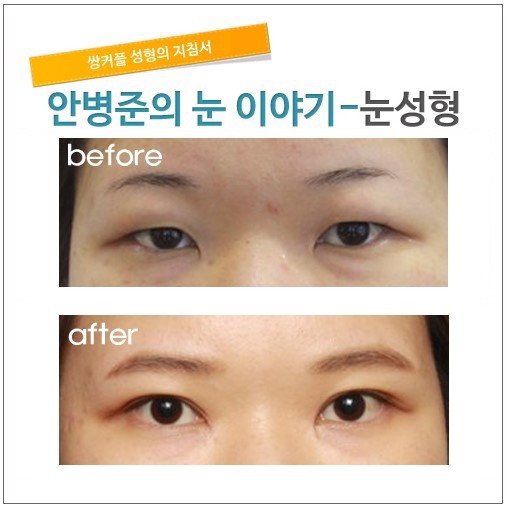 수술후 3개월후.    [안병준의 눈이야기] 관련 이미지 1