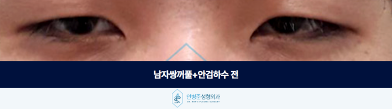남자쌍꺼풀 안검하수 졸려 보이는 인상 눈 뜨는 힘부터 확인해야 합니다 관련 이미지 2
