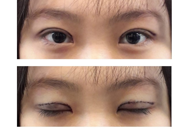 눈성형 수술엔 환자의 협조도 꼭 필요합니다. 관련 이미지 2