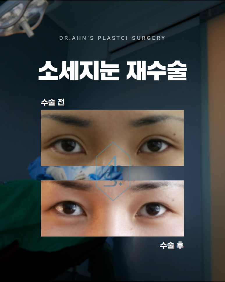 소세지눈 재수술 부기와 구분해야 하는 이유 관련 이미지 1