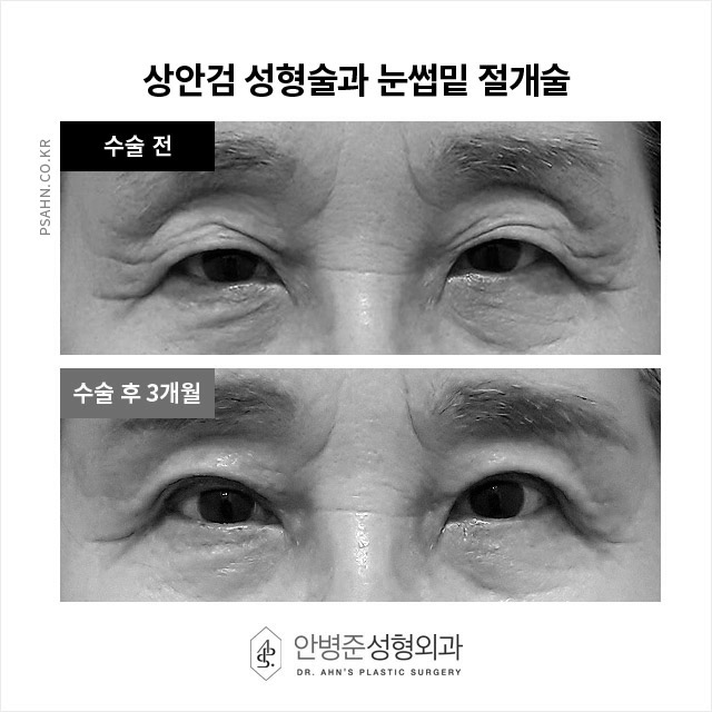 처진눈, 그늘진 눈 밑 노화, 또렷한 눈매와 건강함을 위한 상안검과 하안검 성형술 관련 이미지 2