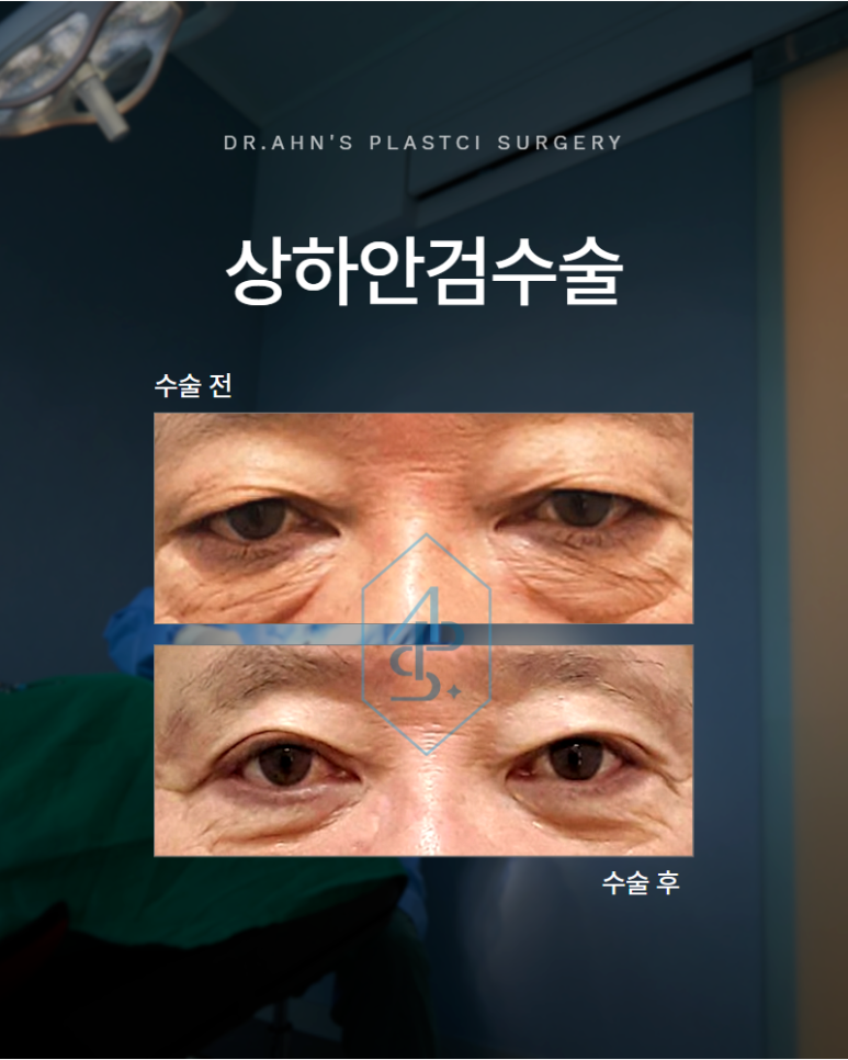 상하안검수술 눈 위아래를 함께 보는 이유 관련 이미지 1