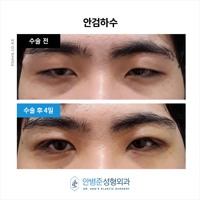 [남자눈성형] 눈의 피로를 덜고 밝은 인상을 되찾는 방법 중 하나! 관련 이미지 2