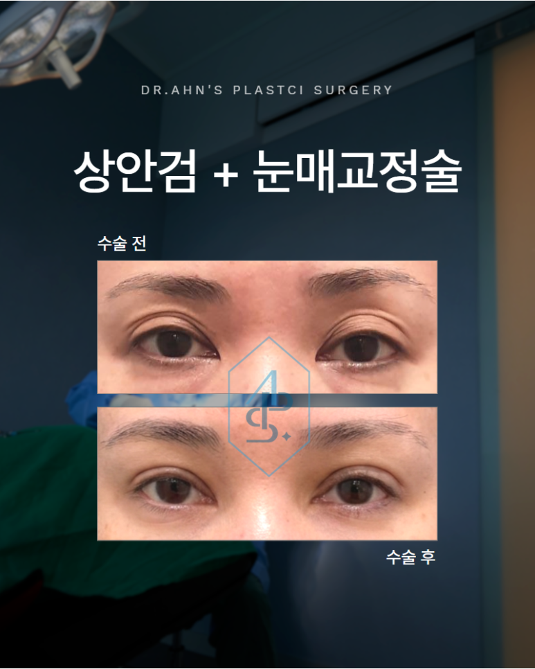 상안검 수술 눈매교정술 함께 정리해야 하는 경우가 있습니다 관련 이미지 1