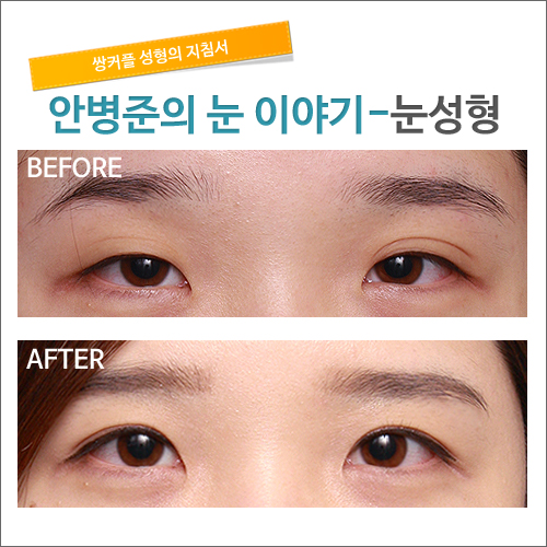 자연스런 쌍꺼풀이란?_시크릿 성형외과 안병준의 쌍꺼풀 지침서 관련 이미지 2
