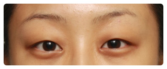 [안병준의 눈이야기]-안병준 성형외과 관련 이미지 1