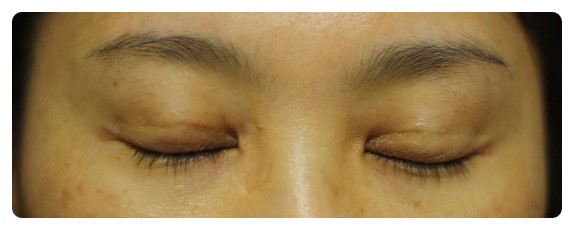 -소시지눈 고치기 과정-        [안병준의 눈이야기] 관련 이미지 2