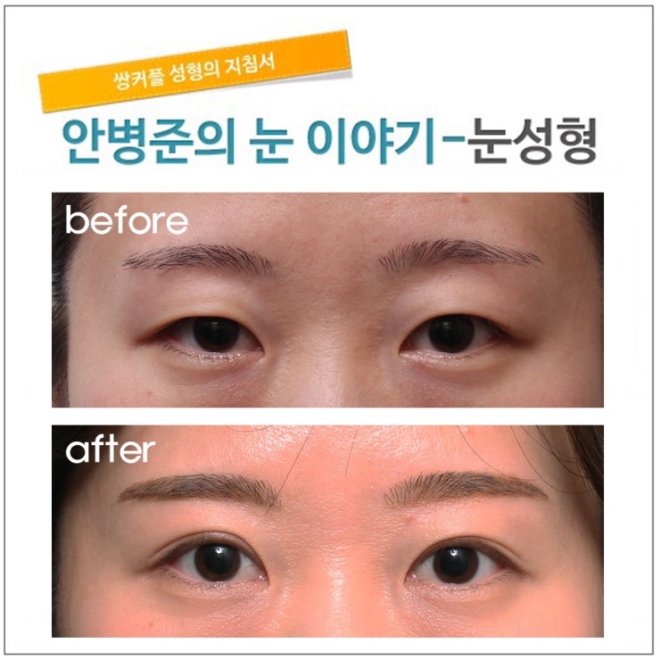 7년전 매몰법 수술후 풀려서 내원한 경우(매몰법,절개법,재수술) 관련 이미지 1