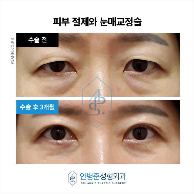 [눈성형] 눈꺼풀처짐과 후천성 안검하수 수술 사례 관련 이미지 1
