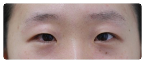 쌍꺼풀,눈매교정 10개월후.         [안병준의 눈이야기] 관련 이미지 1