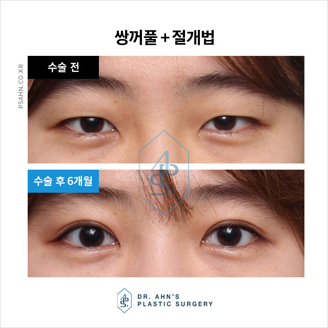 눈꺼풀의 지방과 근육을 적당량 제거하는 두툼한 눈 관련 이미지 2