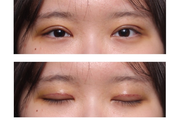 쌍꺼풀과 안검하수3개월후 관련 이미지 3