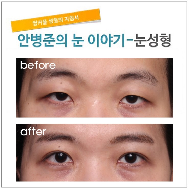 삼백안 교정 관련 이미지 1