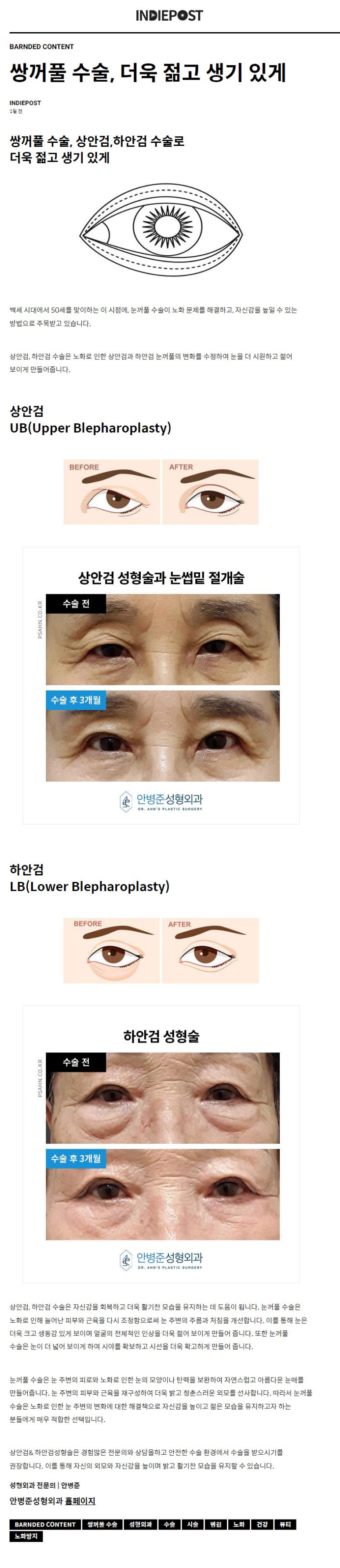 [기사] 상안검, 하안검 수술로 더욱 젋고 생기있게! 관련 이미지 2