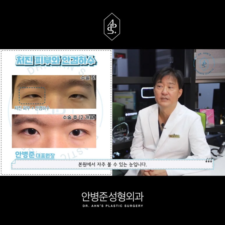 [남자성형외과] 남자 눈성형 쌍꺼풀수술 사례 모음 관련 이미지 3
