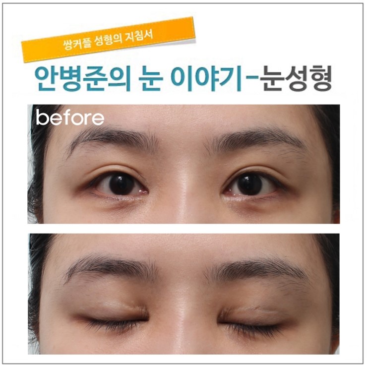 2년전 수술개선(중국환자) 관련 이미지 1