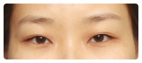 (재수술)라인이 풀어진 경우                [안병준의 눈이야기] 관련 이미지 1