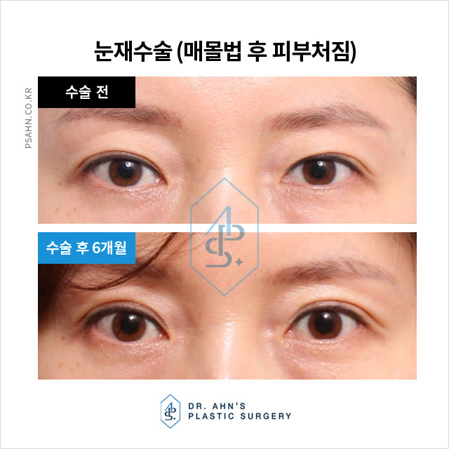 [강남역성형외과] 매몰법 시술 후 피부처짐 재수술 관련 이미지 1