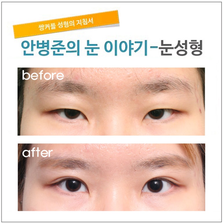 가성 안검하수 관련 이미지 1